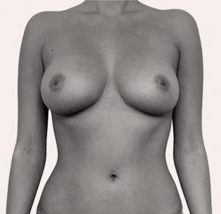 Breast Surgery