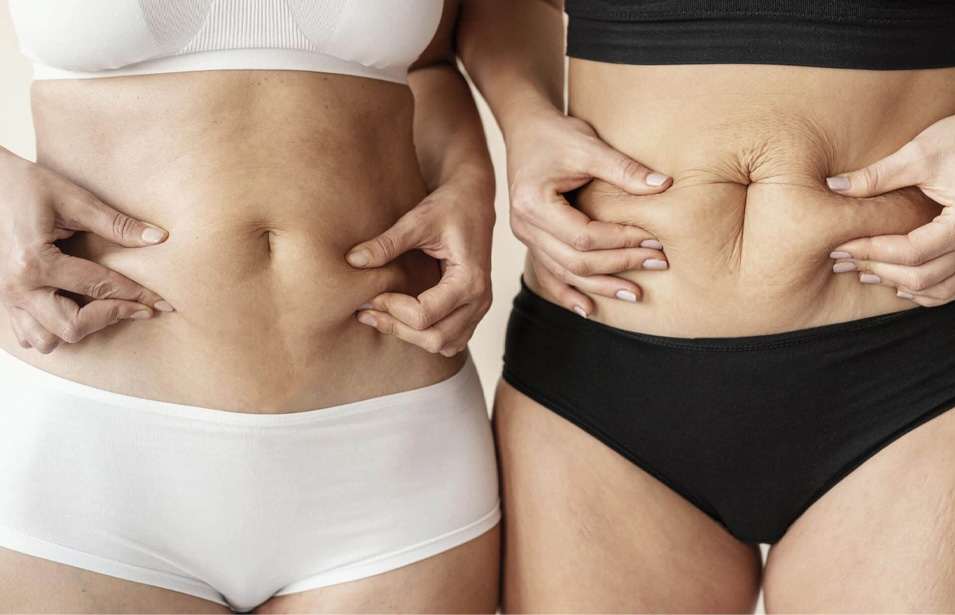 Tummy Tuck