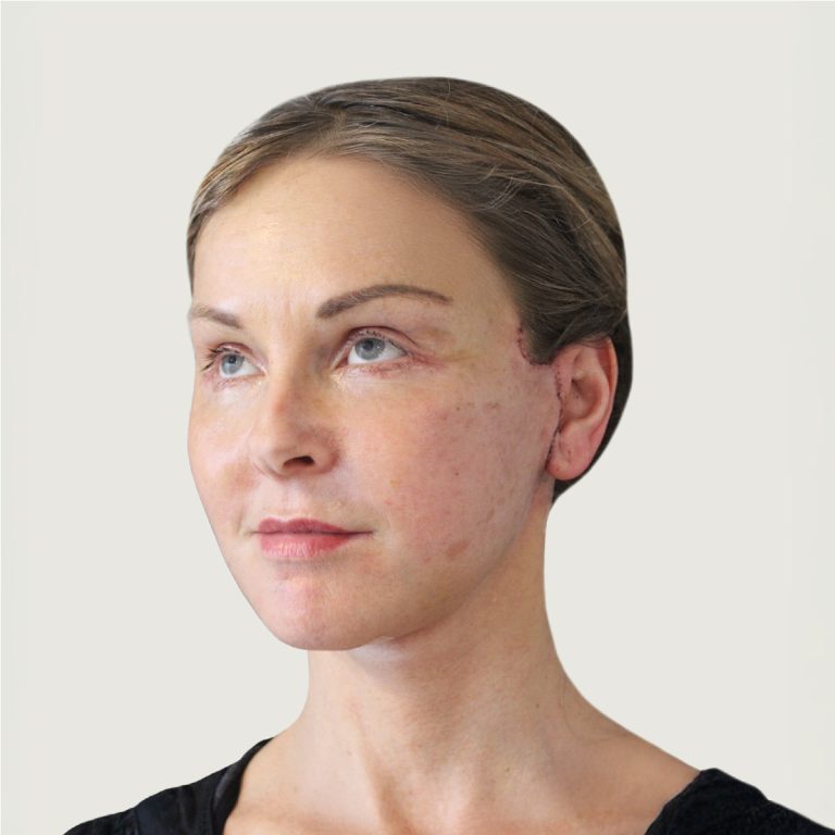 After deep plane necklift