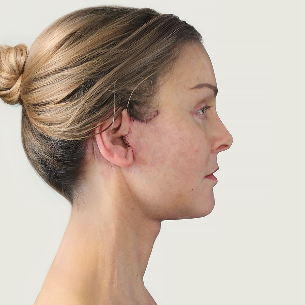 Deep plane face lift after