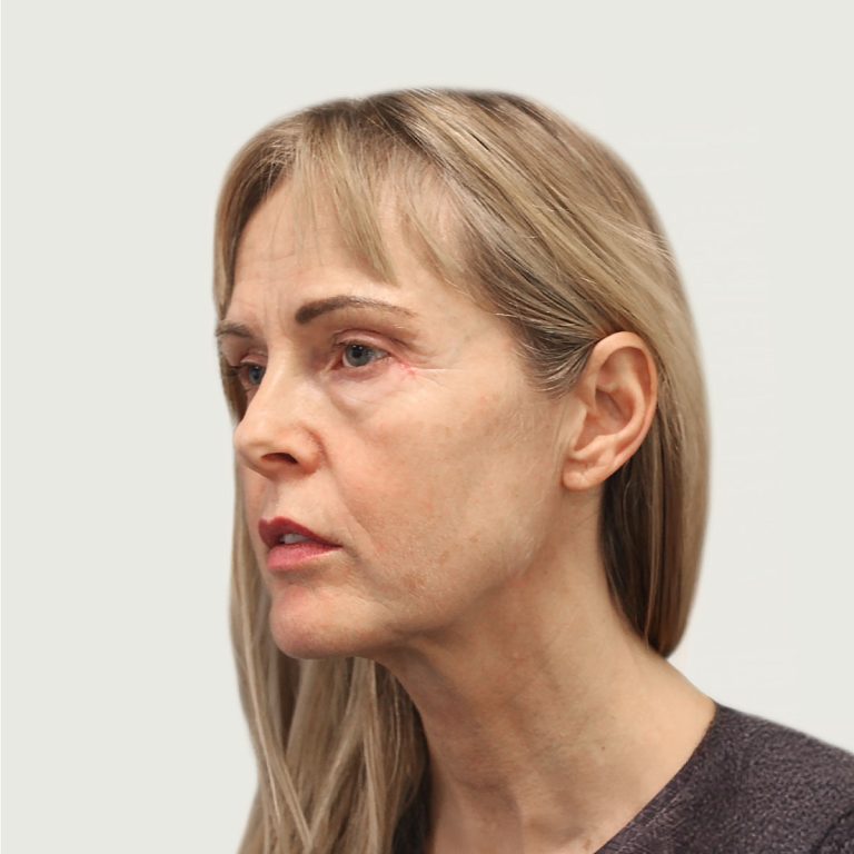 Before deep plane necklift