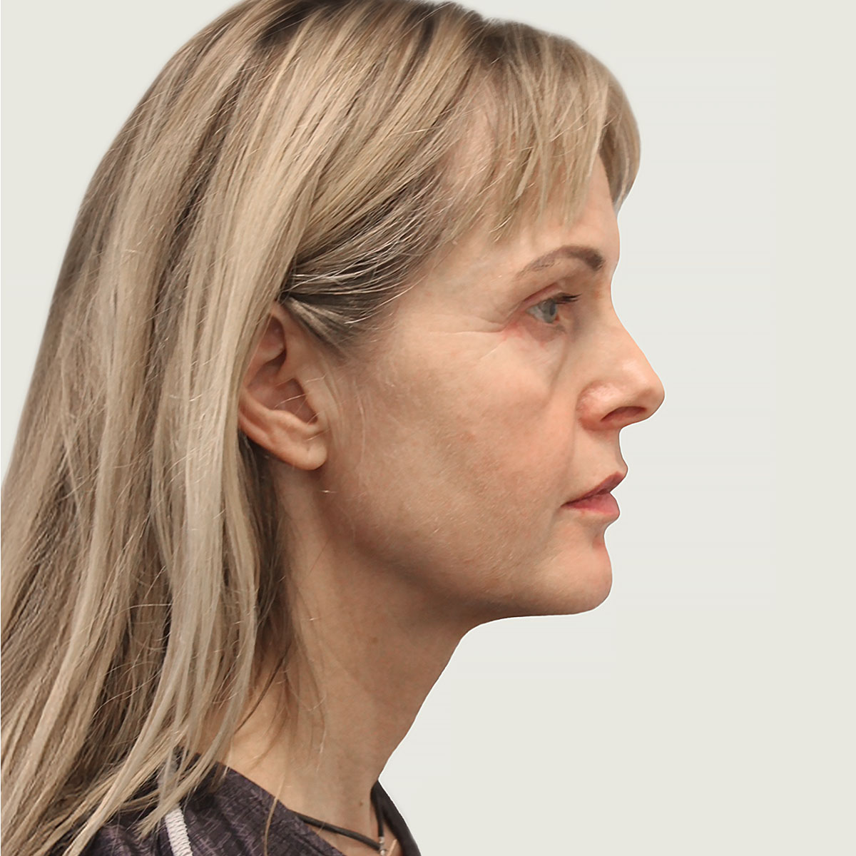 Before plane face lift after