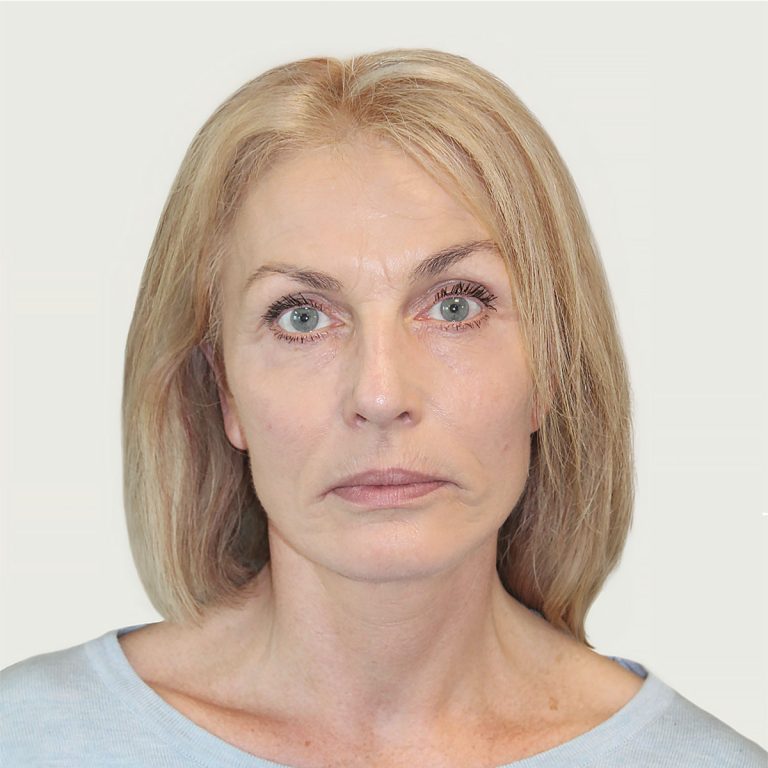 Deep plane facelift from front, after