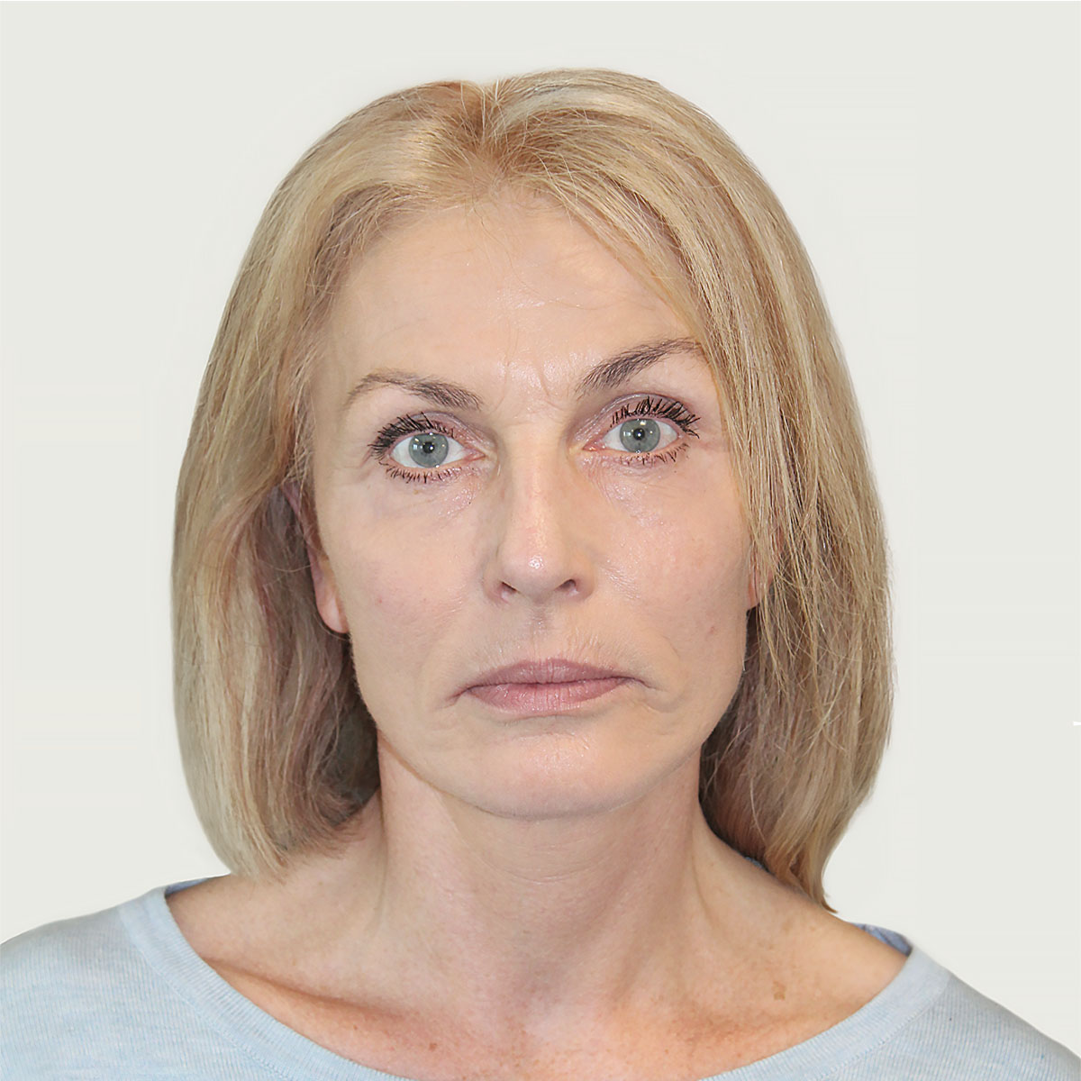 Deep plane facelift from front, after