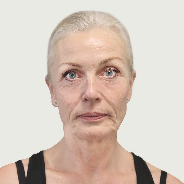 Before deep plane facelift