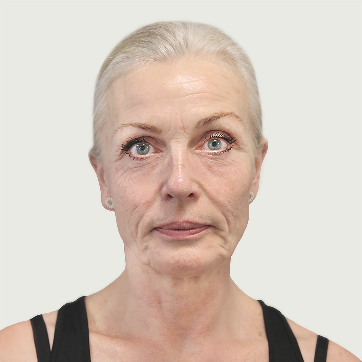 Before deep plane facelift