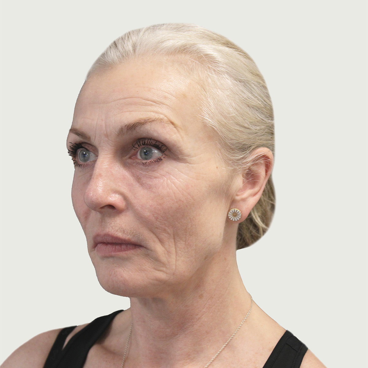 Deep plane facelift from side, before