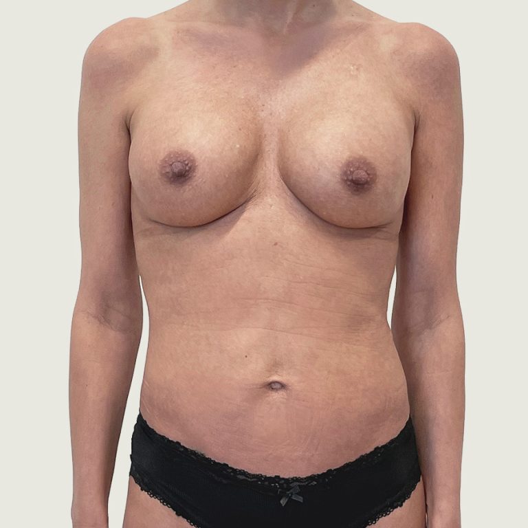 Breast augmentation with implants before