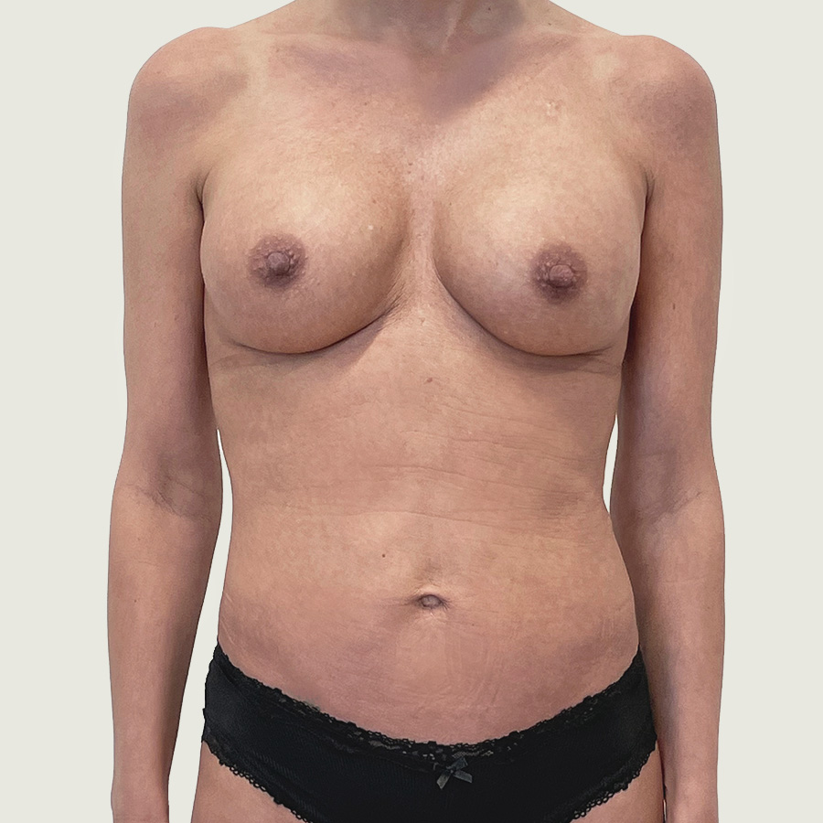 Breast augmentation with implants before