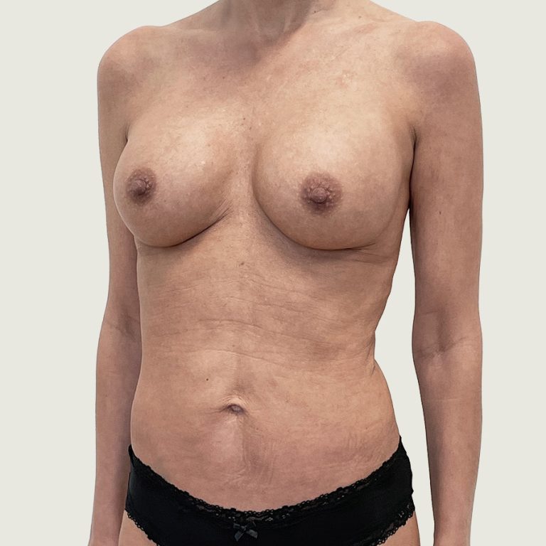 Breast augmentation with implants before