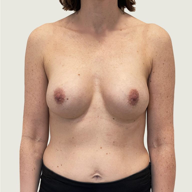 Breast augmentation with implants after from front