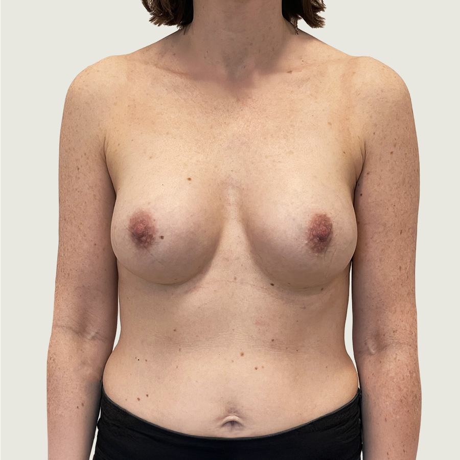Breast augmentation with implants after from front