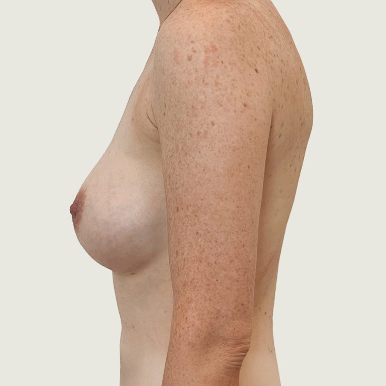 Breast augmentation with implants after