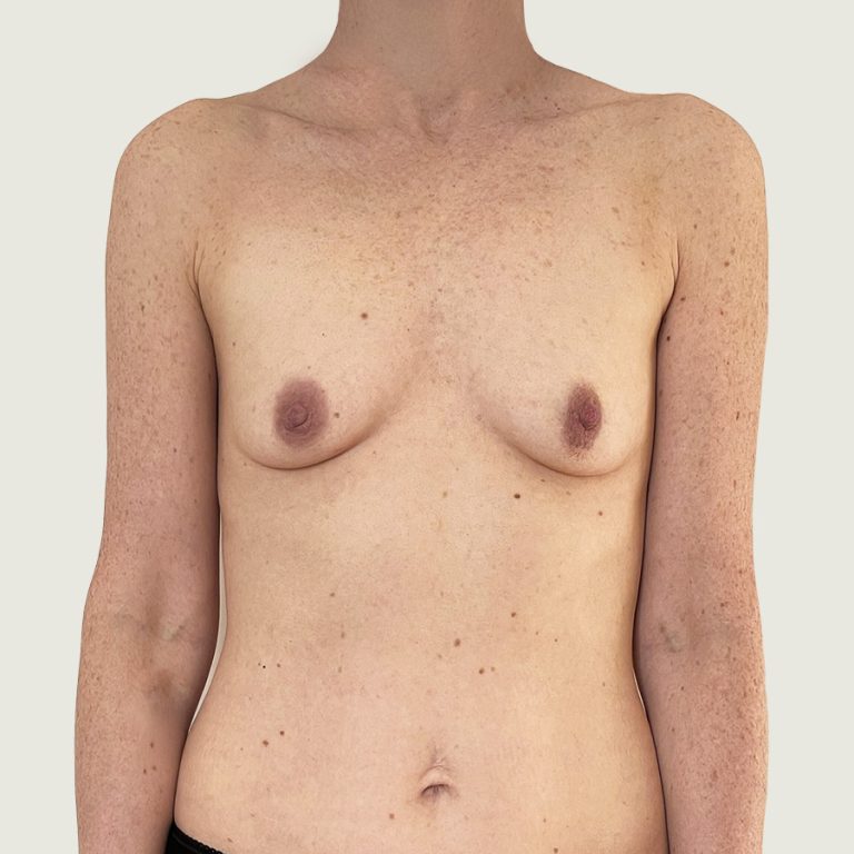 Before Breast augmentation with implants