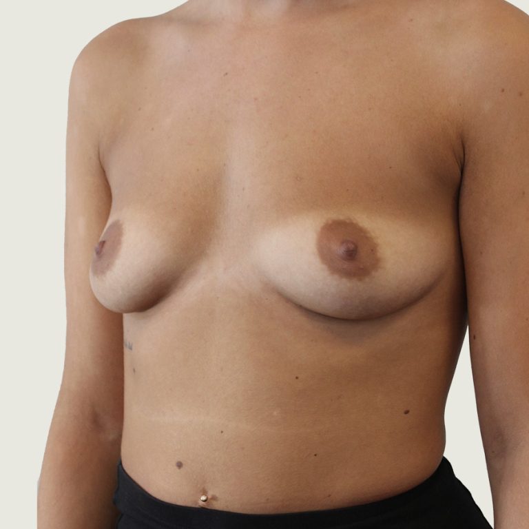 Breast augmentation with implants before