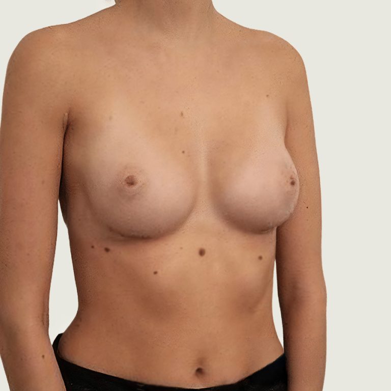 Breast Augmentation with Own Fat after