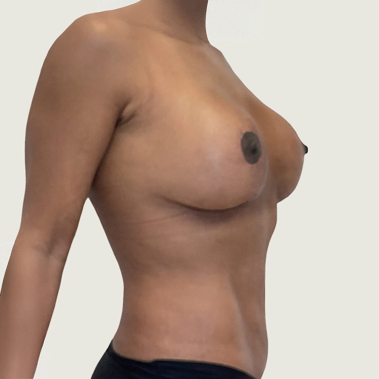 Body conturing after