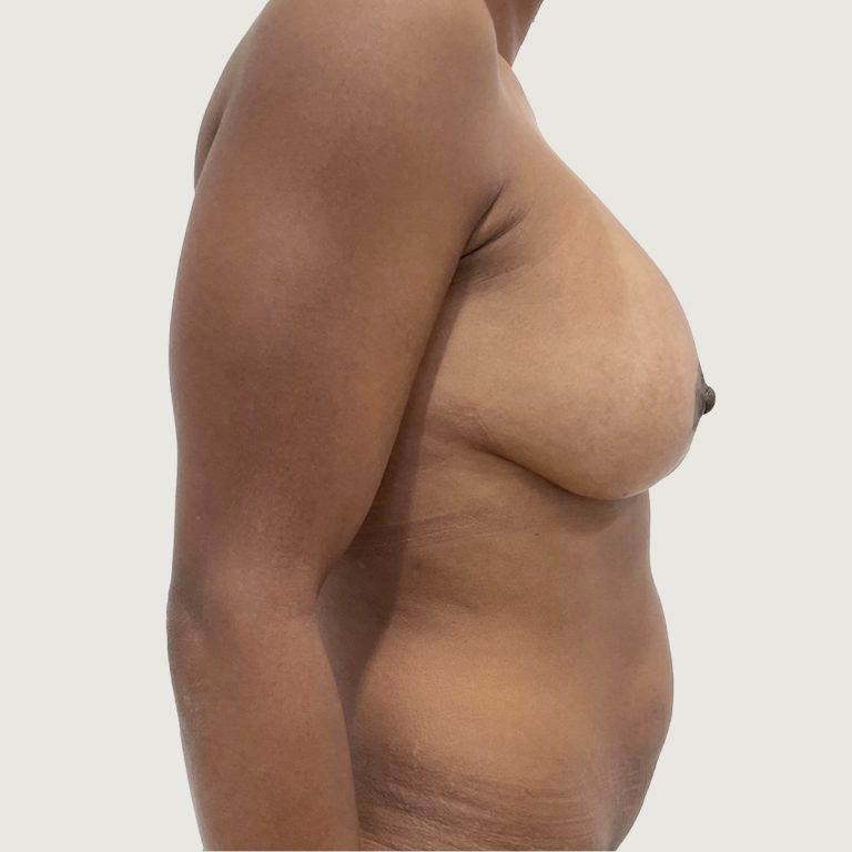 Body conturing before