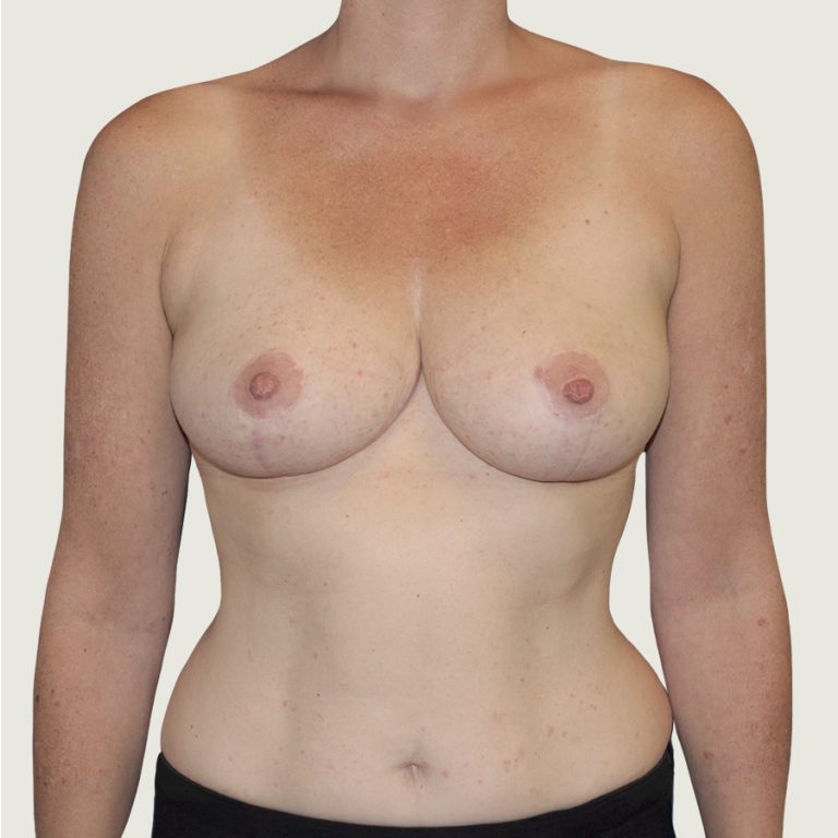 After Breast reduction front