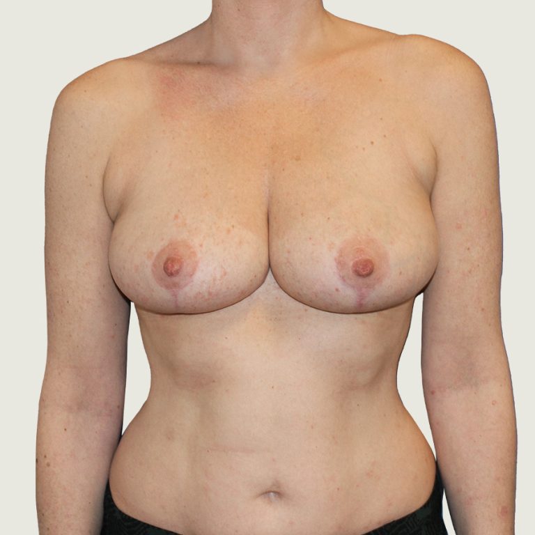 Before Breast reduction