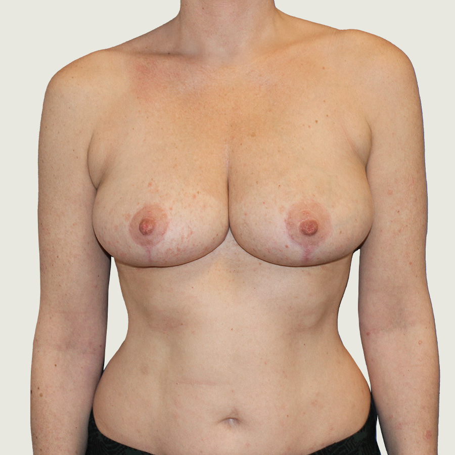 Before Breast reduction