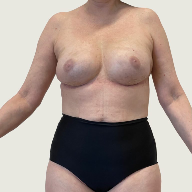 After Breast Reconstruction