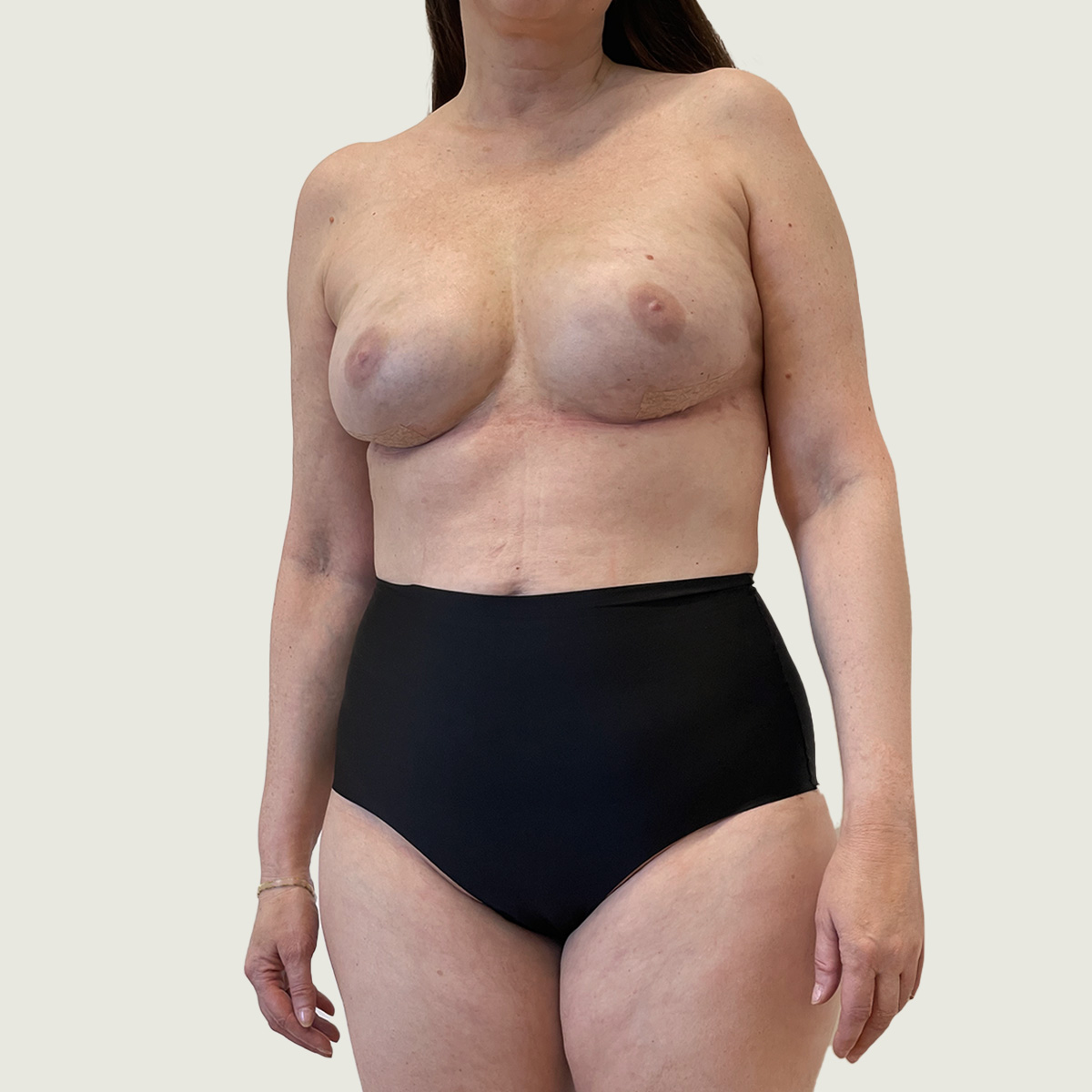 After Breast Reconstruction