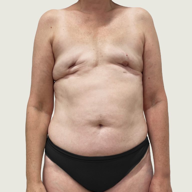 Before Breast Reconstruction