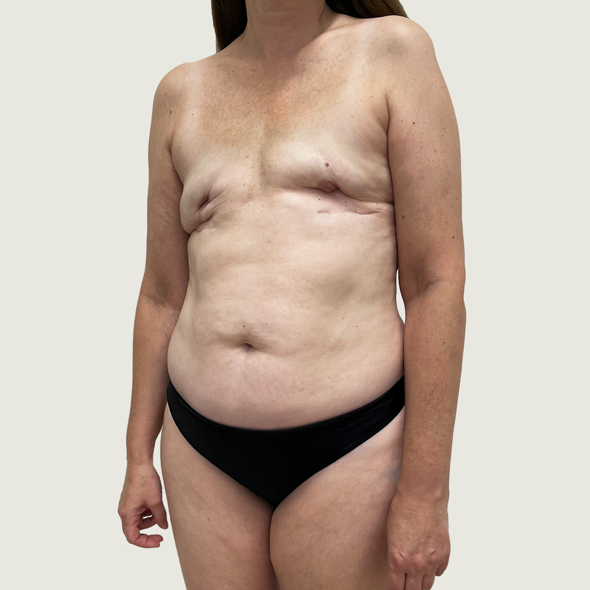 Before Breast Reconstruction