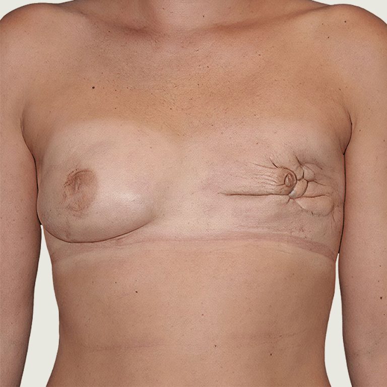 Before Breast Reconstruction