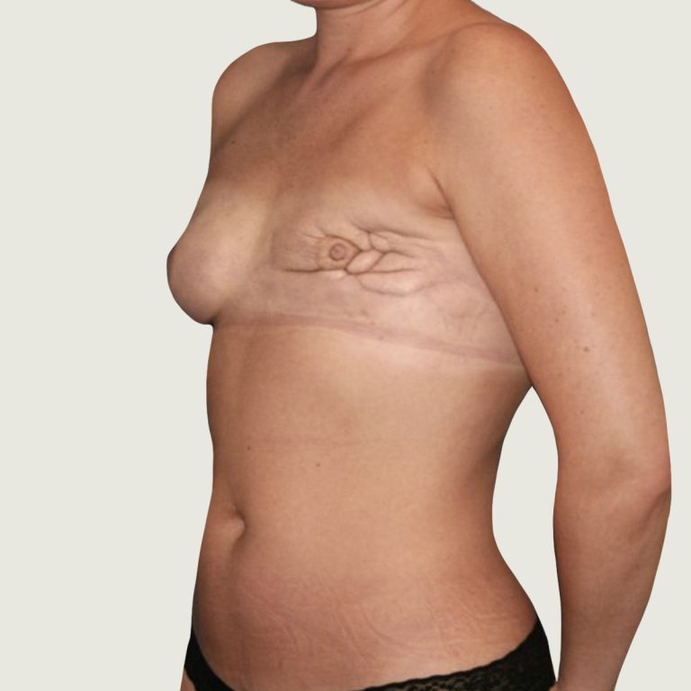 Before Breast Reconstruction