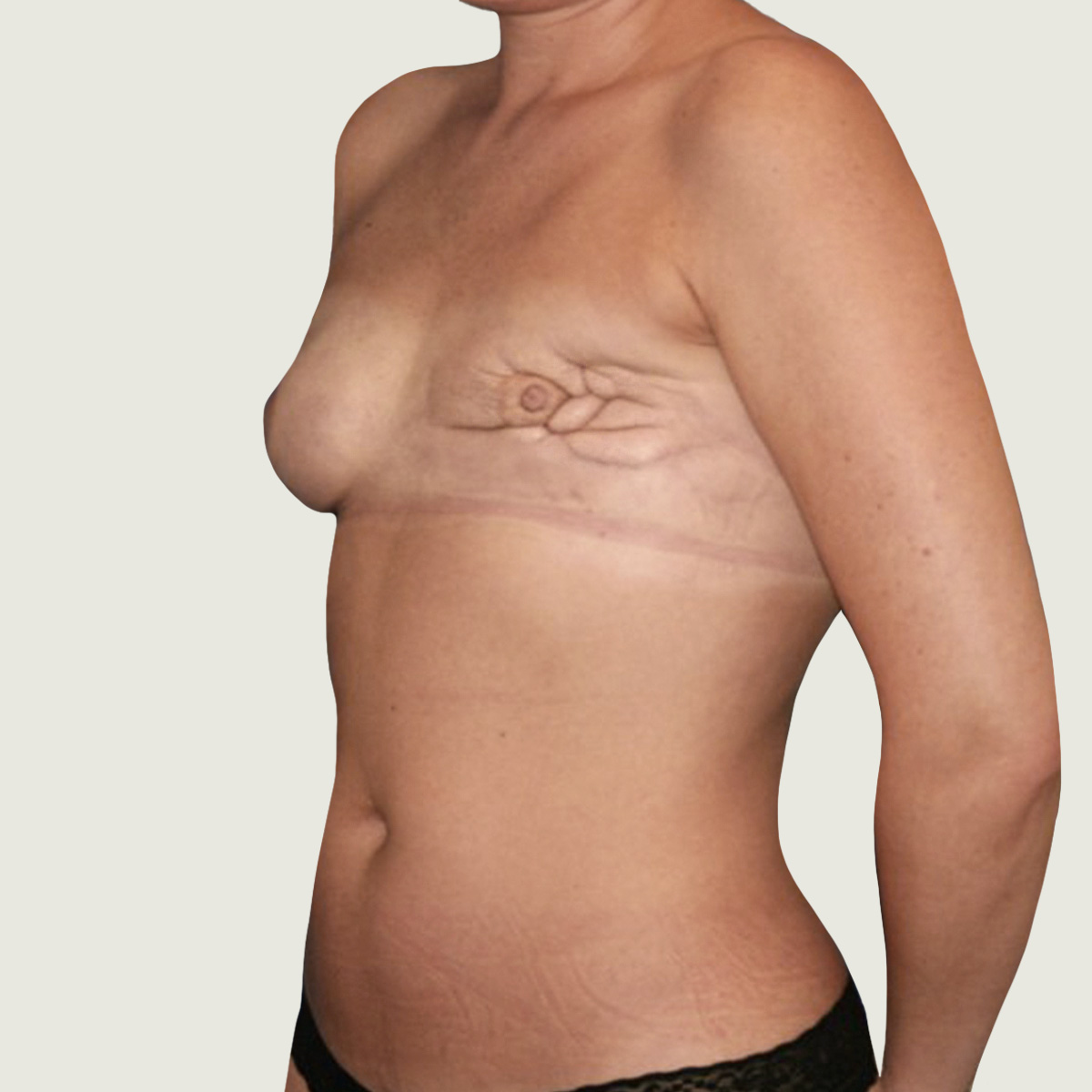 Before Breast Reconstruction