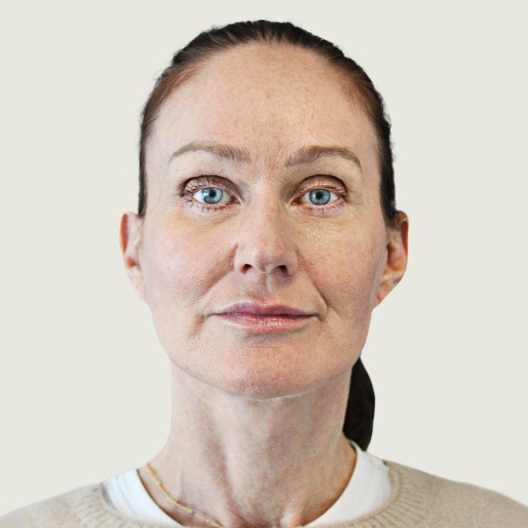 After deep plane necklift