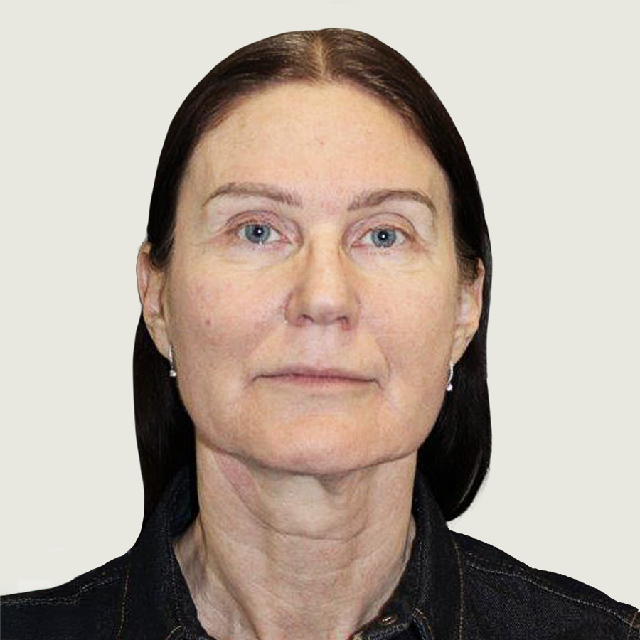 Before deep plane necklift