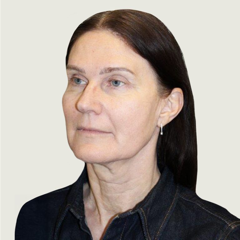 Before deep plane necklift