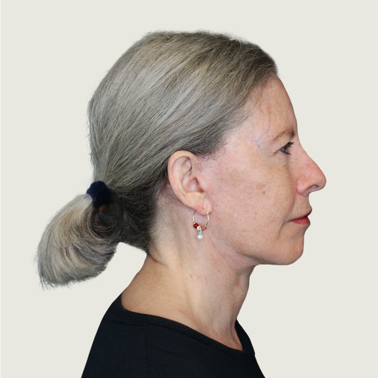 Before deep plane facelift