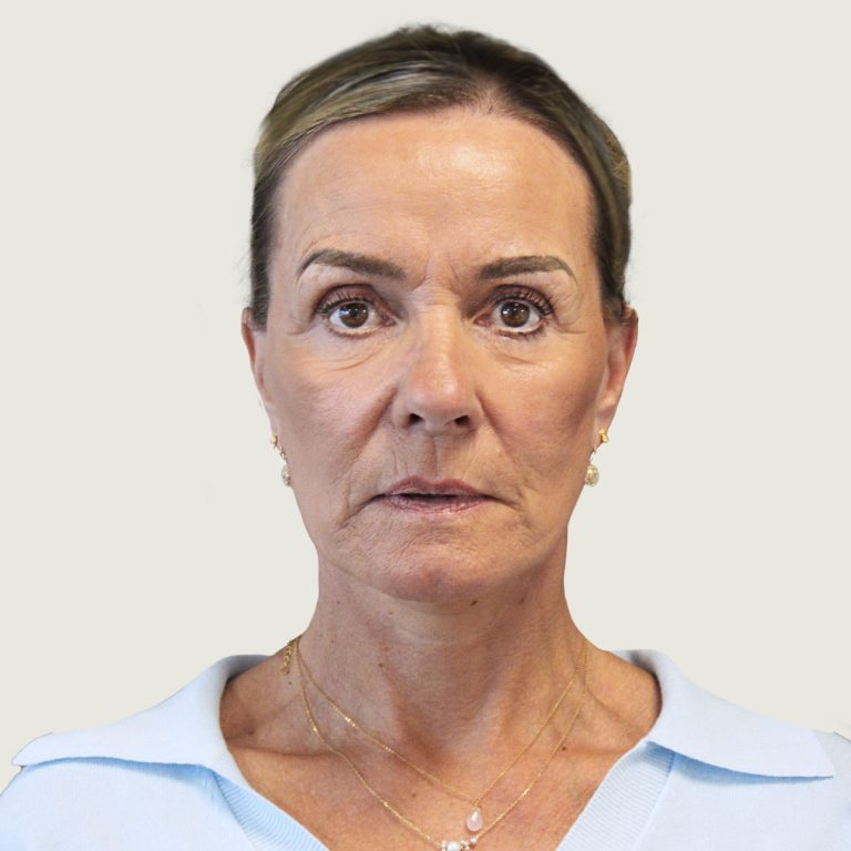 After Deep plane necklift