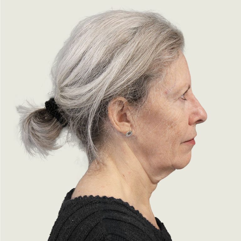 After deep plane facelift