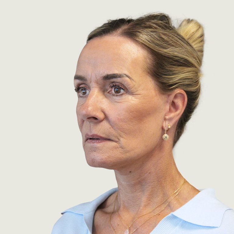 After Deep plane necklift