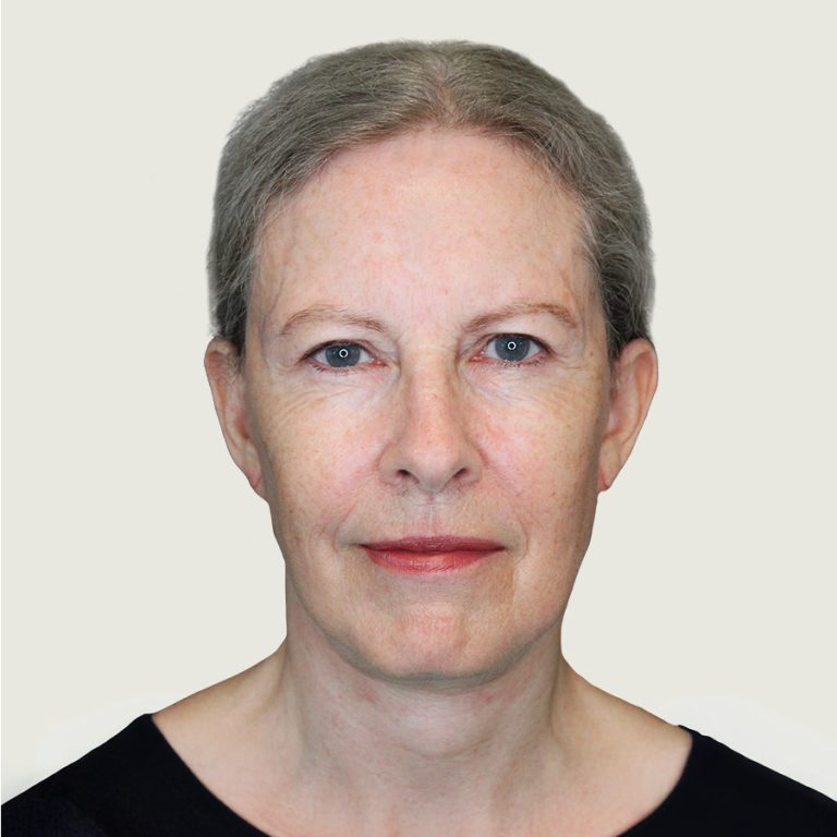 Before deep plane facelift