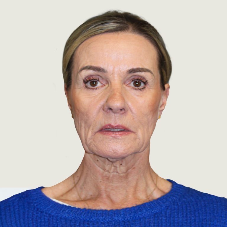 Before Deep plane necklift