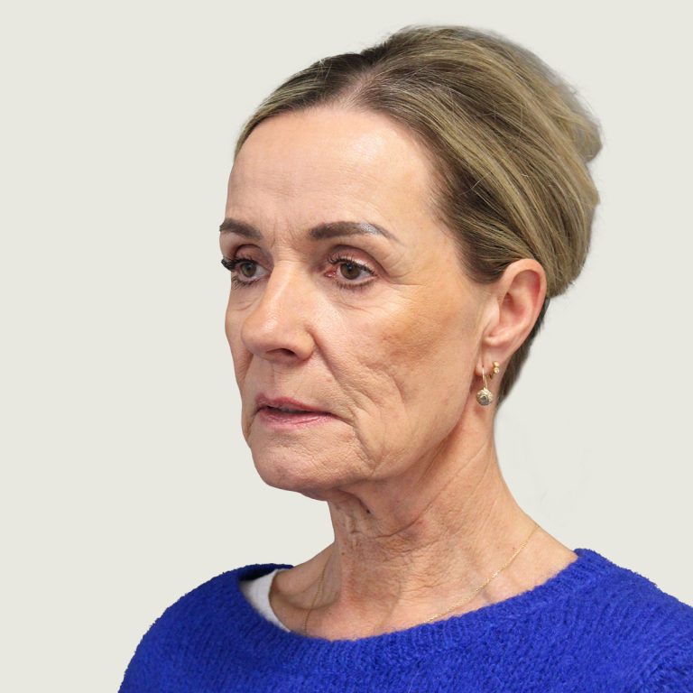 Before Deep plane necklift