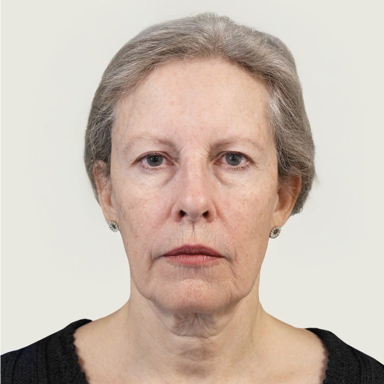 Before deep plane facelift