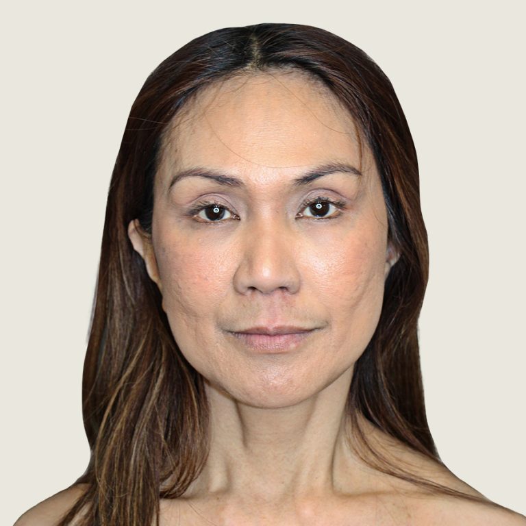 After Ponytail lift front