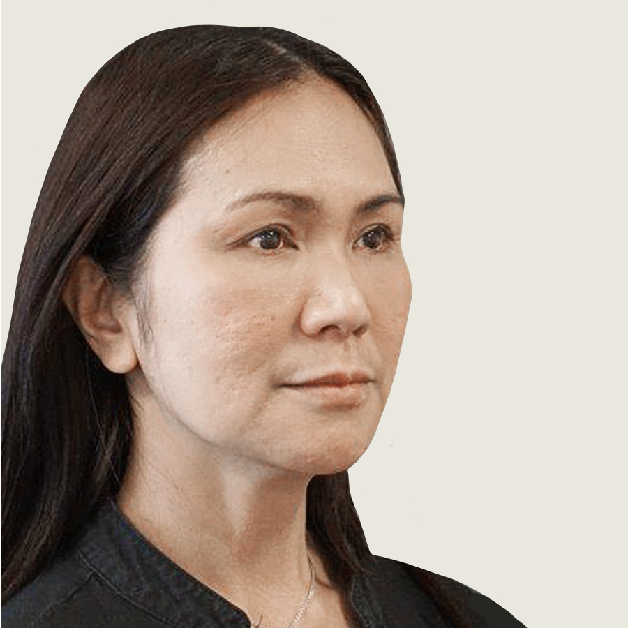 Before Ponytail lift