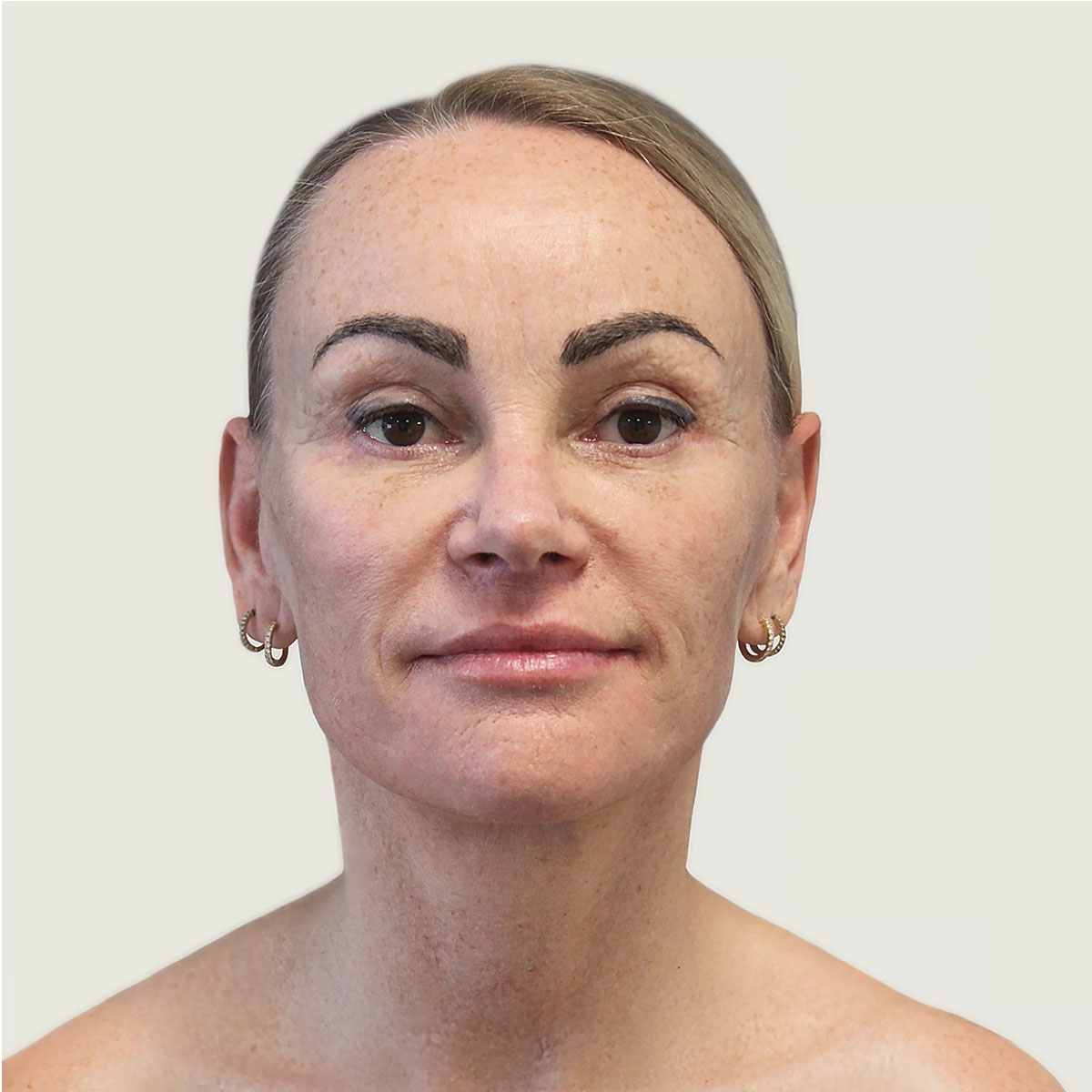 After deep plane necklift