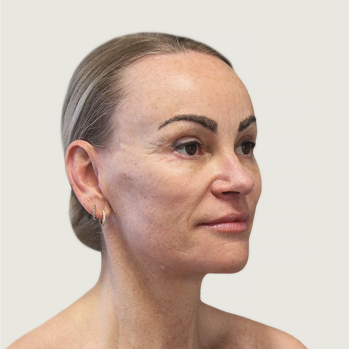 After deep plane necklift from side