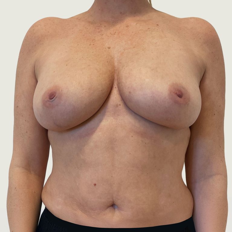 After Replacement of Implants with Own Fat