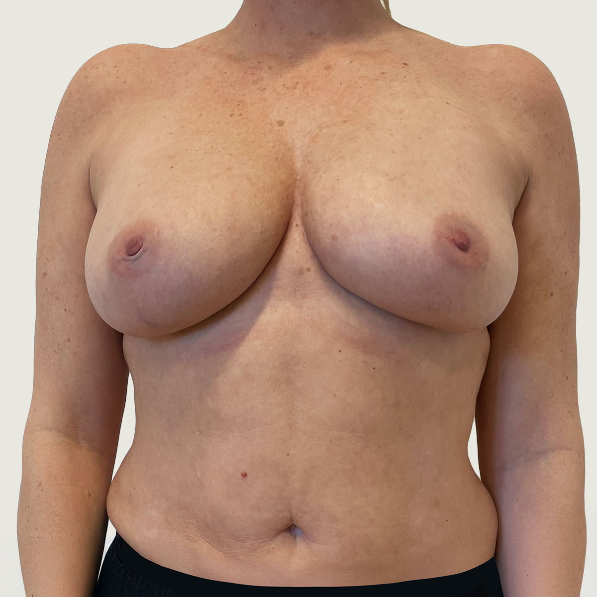 After Replacement of Implants with Own Fat