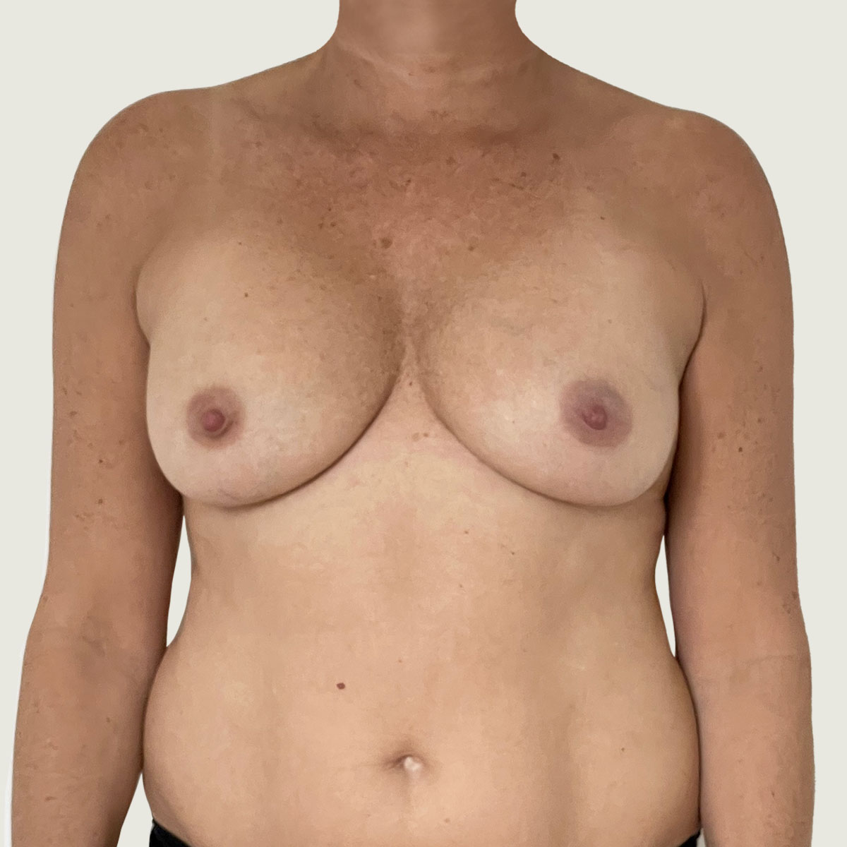 Before Replacement of Implants with Own Fat